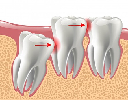 Illustration of impacted wisdom tooth