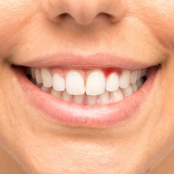 Smile with signs of gum disease in Lewisville, TX