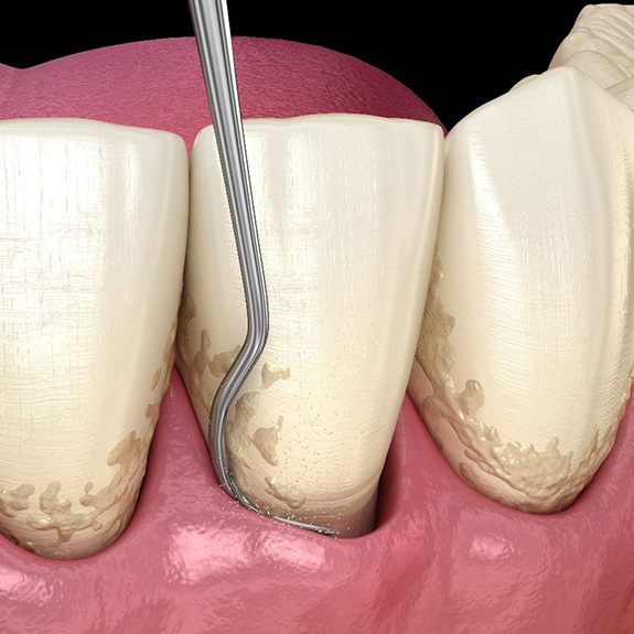 Illustration of scaling and root planing for gum disease in Lewisville, TX