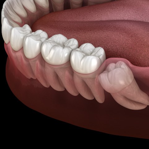 Illustration of wisdom tooth developing