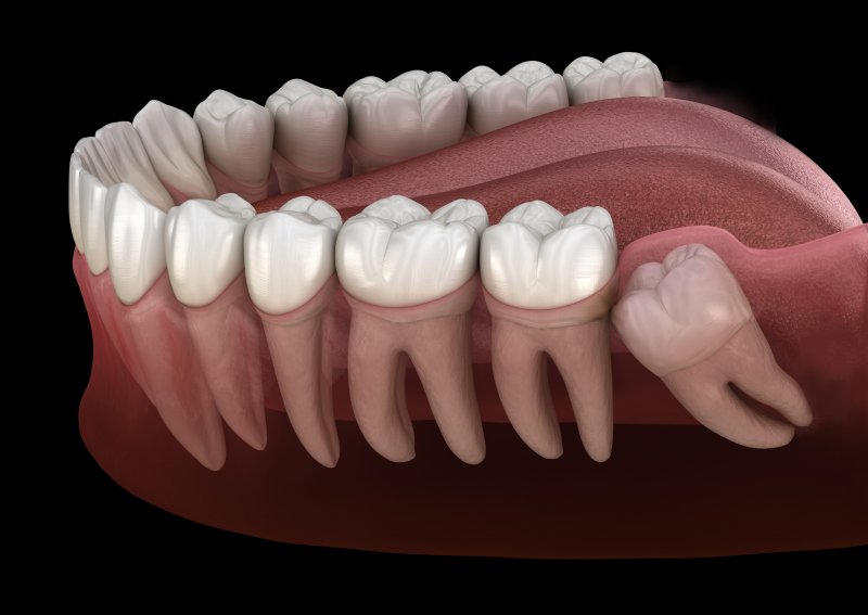 Impacted wisdom tooth illustration